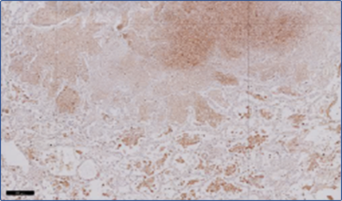 Figure 2. C1q staining of a lung of a patient suffering from active TB (adapted from Lubbers et al 2018). C1q levels are not only increased locally, but also systemically in serum and at the mRNA level in circulating cells.